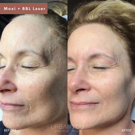 laser moxi bbl urban  med spa
