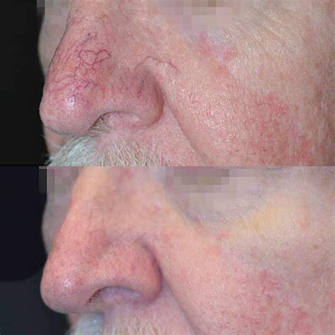 Vascular Laser Brisbane — Significant Results in 2-6 Weeks