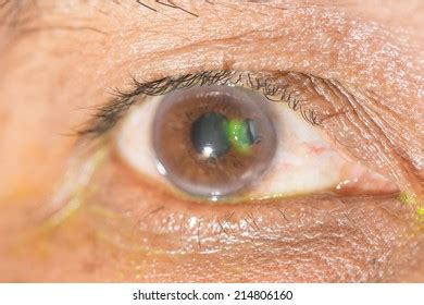 Close Ruptured Globe During Eye Examination Stock Photo 214806160 | Shutterstock