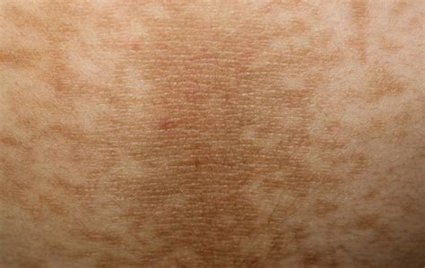 A Closer Look at Different Diabetic Rash Types and Other Skin Conditions