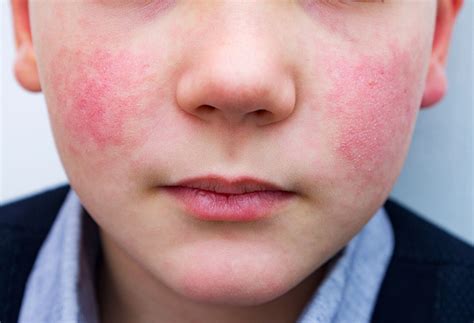 Understanding Common Rashes In Kids | The Well by Northwell