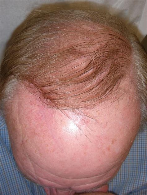 Mohs and Plastic Surgery for Atypical Fibroxanthoma on Scalp | Case 36738