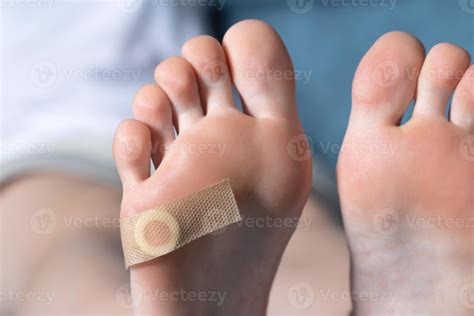 Woman's foot with glued medical plaster for plantar wart. Treatment of