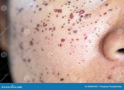 lesions skin caused  acne   face   clinic stock image