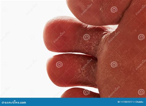 Foot is a fungal infection stock image. Image of barefoot - 117351517