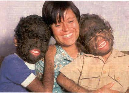 Basic Info - Hypertrichosis (a.k.a Werewolf Syndrome)