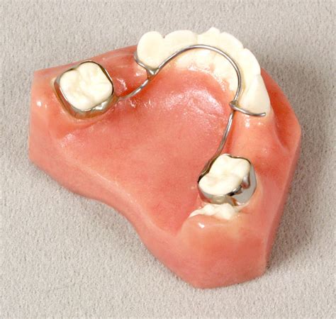 mandibular fixed bilateral space elrhov
