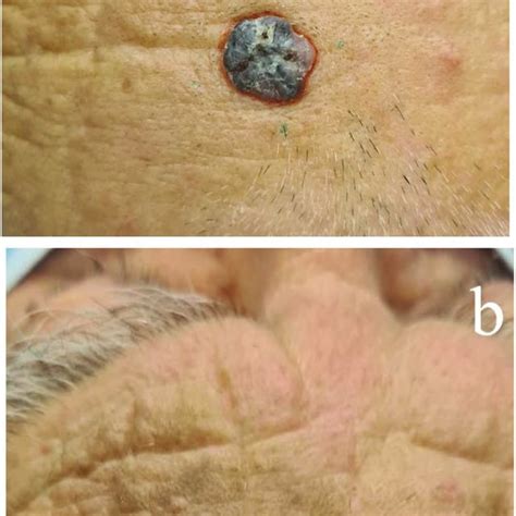 Basal cell carcinoma of the forehead (control, only clinically... | Download Scientific Diagram