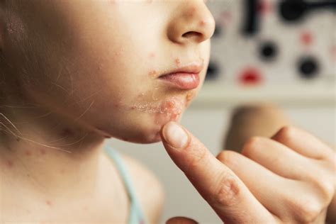 diagnosing postherpetic neuralgia painscale