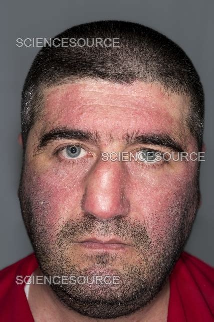 atopic dermatitis stock image science source images