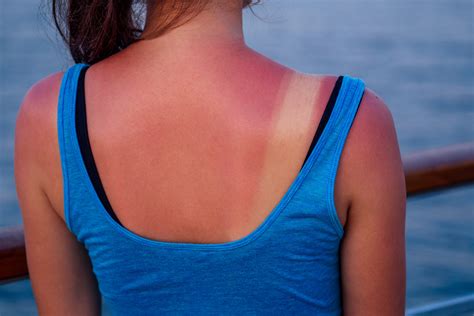 sunburn  symptoms home remedies  treatment