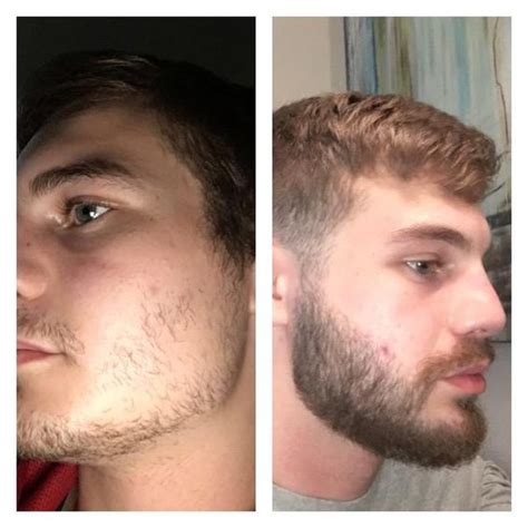 Minoxidil Before And After Beard Result : If you've tried to grow one overnight, then you know ...