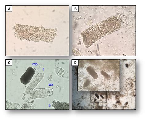 Urine Sediment of the Month: Granular & "Muddy Brown" Casts - Renal Fellow Network