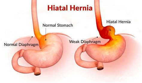 HIATAL HERNIA – CSF Surgery