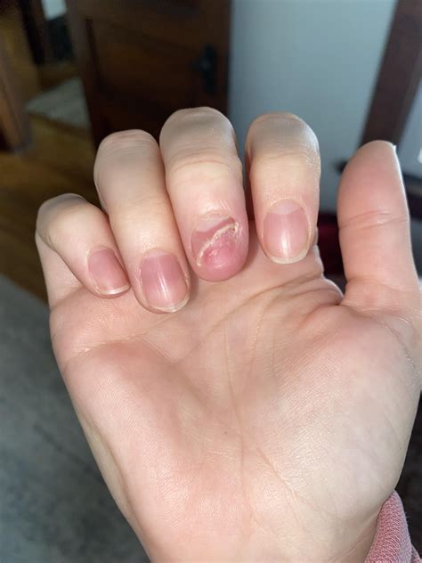 Is my fingernail wart finally gone? Pics now vs where it started : r/Warts