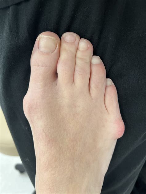 Minimally Invasive Bunion Surgery | Northwest Surgery Center