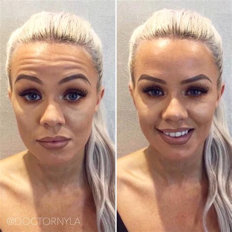 will botox help bags under eyes 1