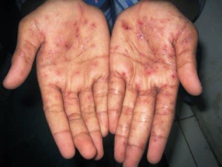 penyakit scabies  dalchaebi
