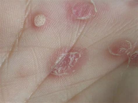 Secondary Syphilis | PPT