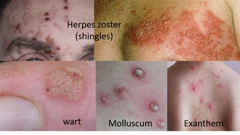 skin infections types predisposing factors  health measures