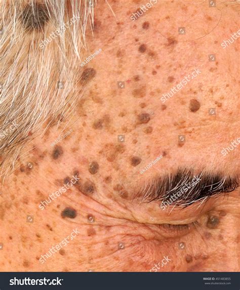 Senile Keratosis