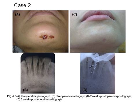 The case of persistent sinus tract of facial area from dental origin