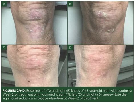 Topical Management of Plaque Psoriasis—A Review and Case Series ...