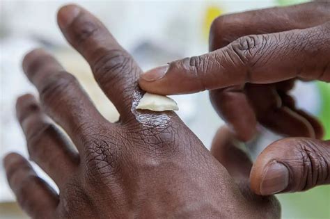 how to remove bandage glue from skin 9