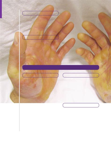 Bullous pemphigoid | Osmosis