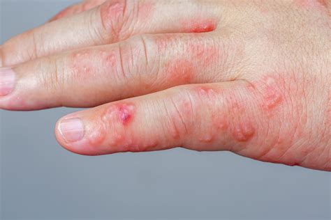 Some Autoimmune Inflammatory Rheumatic Disease Patients Developed