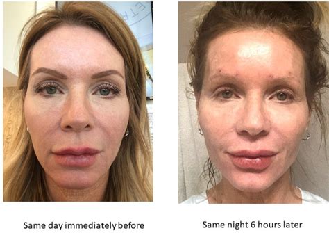 My Experience with Silhouette InstaLift(TM) Face Thread Lift Before ...