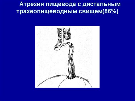 Атрезия пищевода и пилоростеноз - презентация онлайн