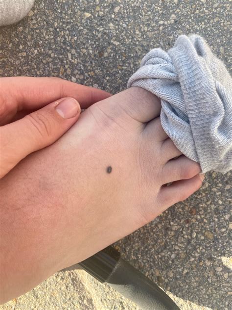 What is this Black spot on foot? 2+ years : r/DermatologyQuestions