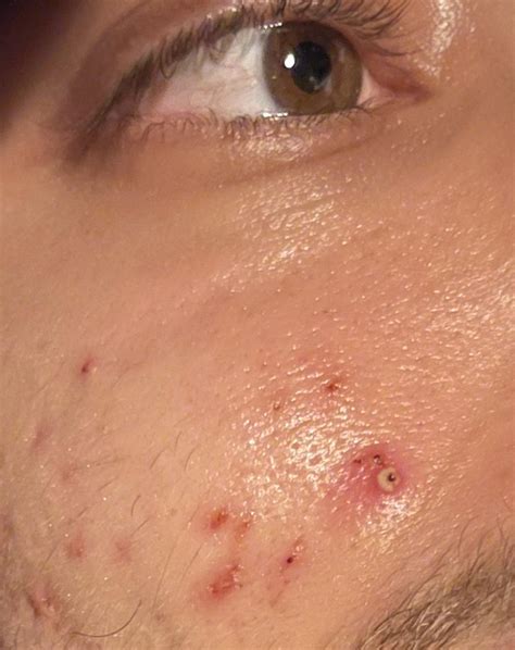 Unbelievable Blackhead Removal 2024: The #1 Tip Dermatologists Use Image 20