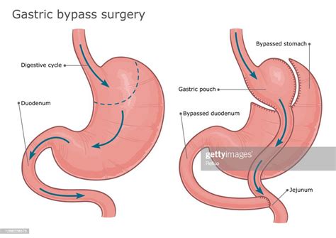 gastric sleeve surgery  gastric bypass