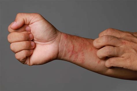 Eczema Treatment | Gentle Care, Soothing Relief | DermDox