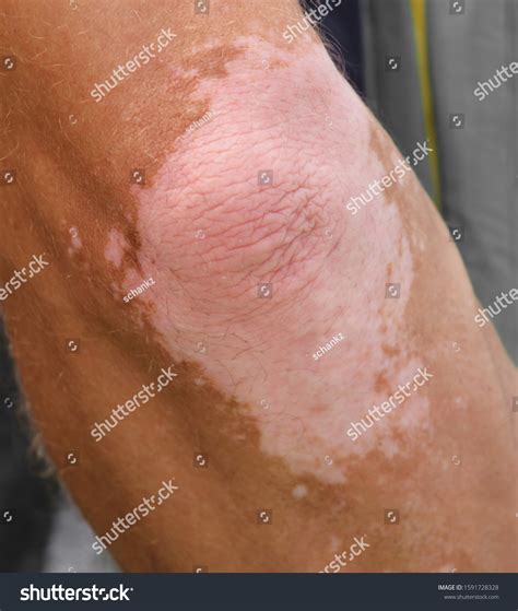 White Spots On Hand Skin Disease Stock Photo (Edit Now) 1591728328