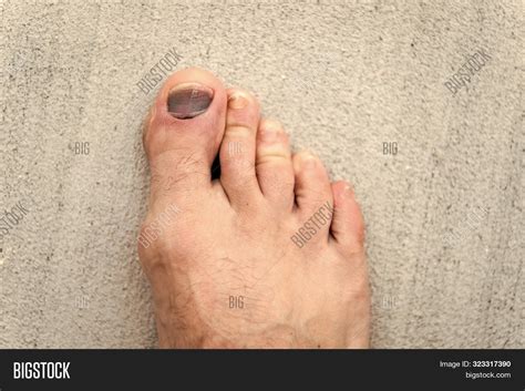 Imagen y foto Nail Hematoma. Take (prueba gratis) | Bigstock