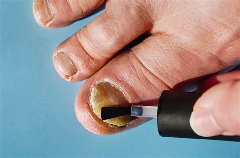 nail fungus advance foot clinic podiatry
