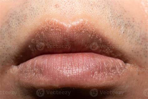 Fordyce Spots On Lips Photos | Lipstutorial.org