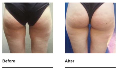 Cellulite Reduction - Your Health District