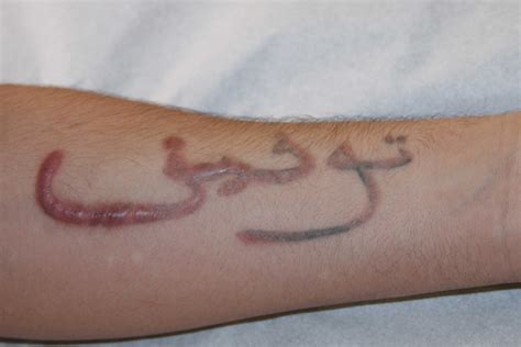 removed tattoo scar 8