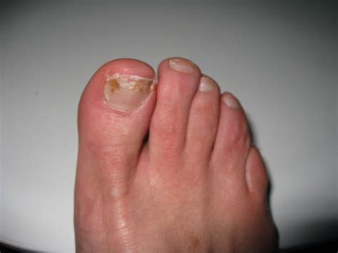 nail fungus treatment lonsdale skin laser clinic