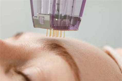 Acne treatment with monopolar radiofrequency needling
