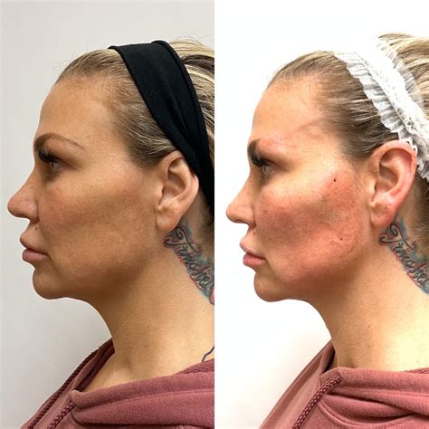 pdo thread lift  newport beach ca beauty boost med spa