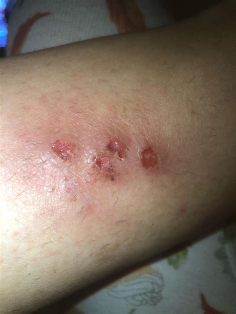 What is this??? Folliculitis? Ingrowns? Scabs? Infected? : r/Folliculitis