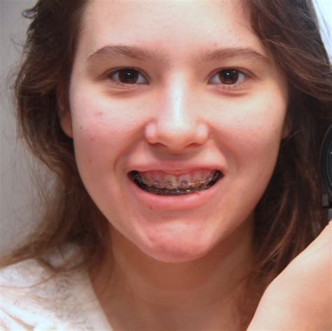 Seriously Peppermint: My new smile