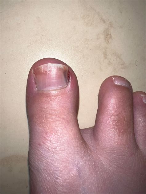 Toenail edge bleeding - not sure what the problem is or when I should