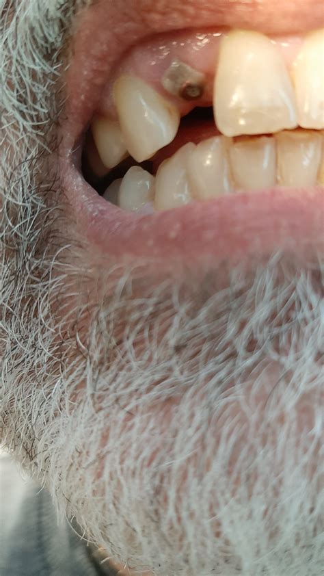 is white Gums normal after implant uncovering ? : r/askdentists