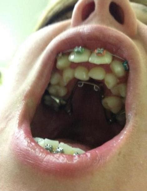 Supernumerary Teeth